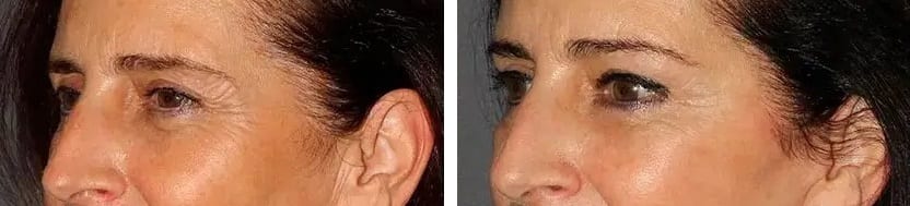 Cirugía de la Mirada caso 2 — antes y después